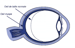 schéma oeil myope / oeil normal